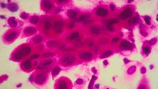 Close-up view of cancer cells.