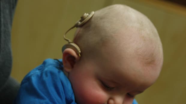 An infant with a cochlear implant.