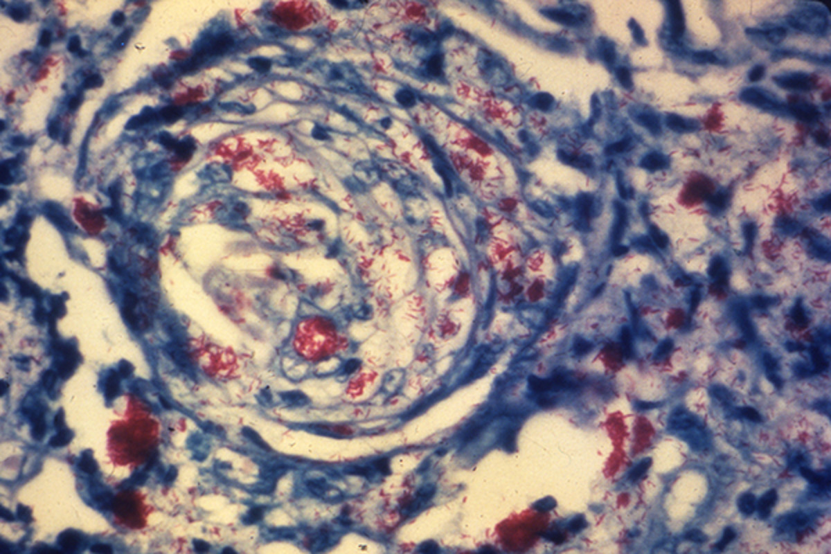 Skin biopsy reveals a nerve infiltrated by Mycobacterium leprae (red-staining) bacteria. (PHOTO: CDC'S PUBLIC HEALTH IMAGE LIBRARY)