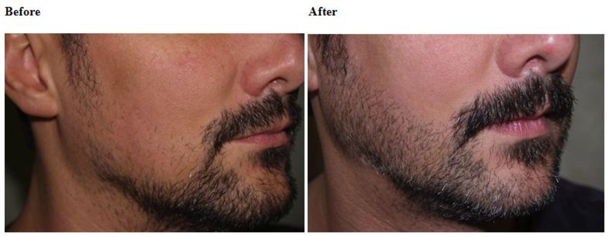 Are Hipsters to Blame for a Rise in Facial Hair Transplants? - Pacific  Standard
