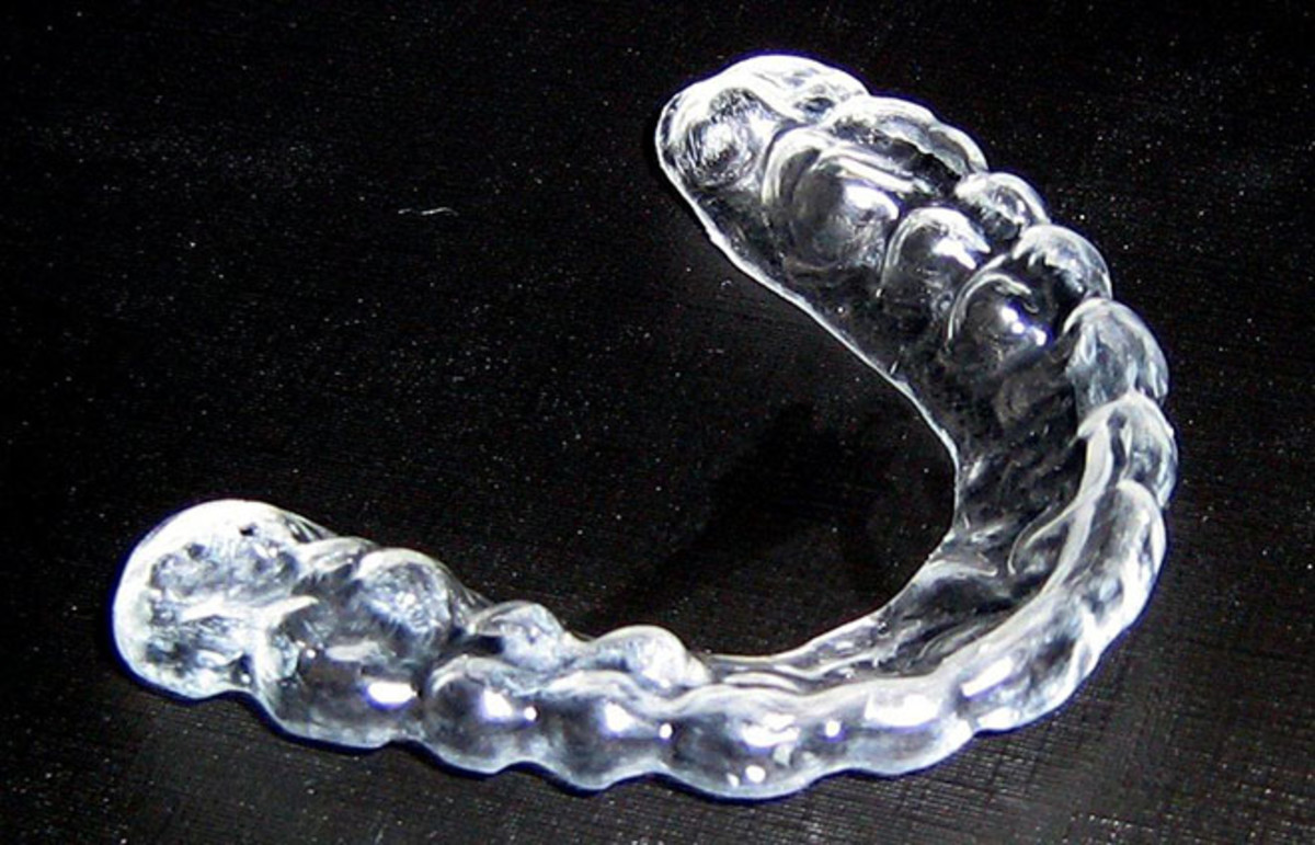 An example of a mouthguard. (Photo: Mik81/Wikimedia Commons)
