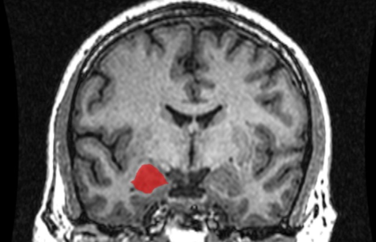 The left amygdala. (Photo: Wikimedia Commons)