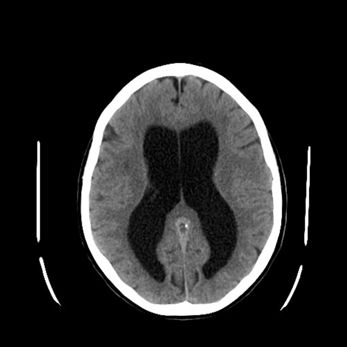 Hydrocephalus, an accumulation of cerebrospinal fluid, can accompany SBS. CT scanning is one technique used to diagnose the condition. (Photo: Lucien Monfils/Wikimedia Commons)