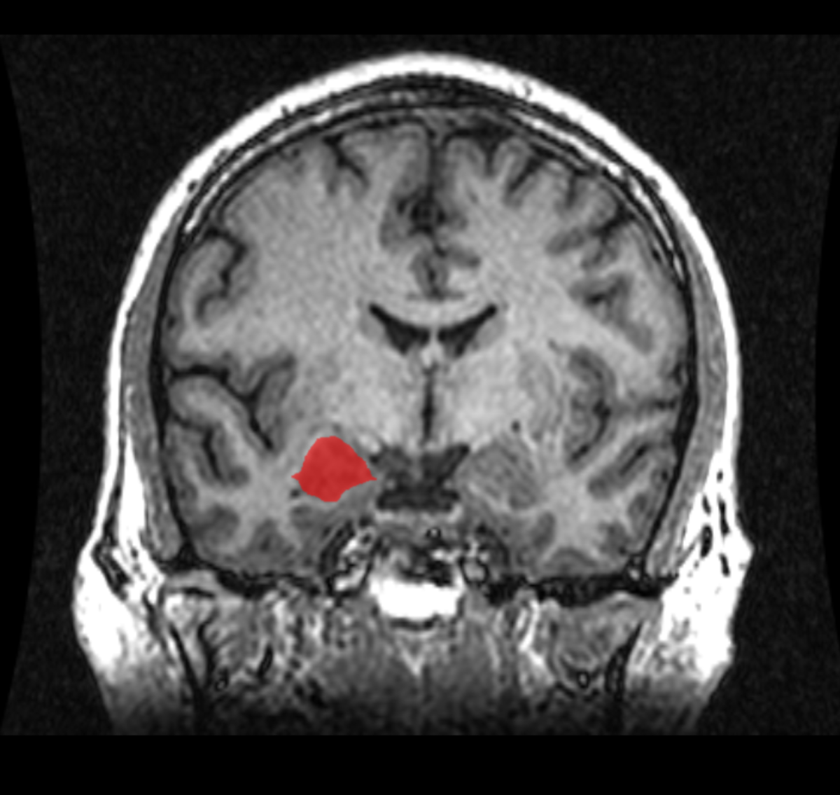 An MRI showing the right amygdala in red. (Photo: Public Domain)