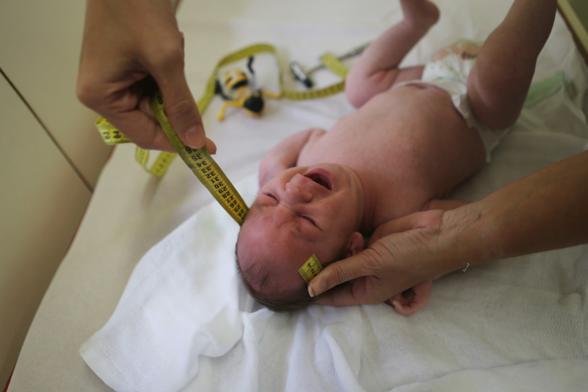 A doctor measures the head of a baby with microcephaly.