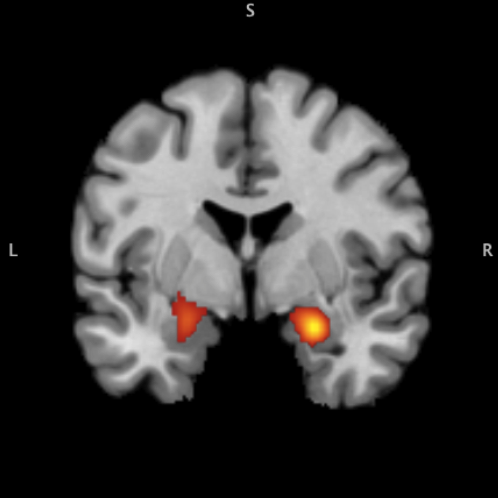 Youth with a history of trauma exhibit a hyperactive amygdala response to negative emotional cues. (This image originally appeared in Tyler C. Hein and Christopher S. Mark's 