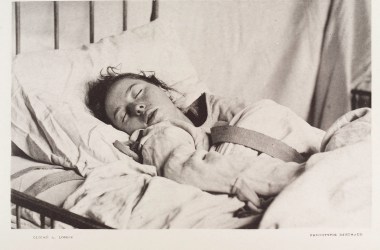 A female patient diagnosed with "sleep hysteria" wearing a straitjacket, 1888.
