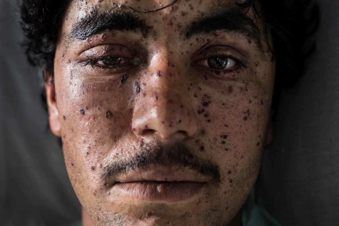 Lashkar Gah, Afghanistan: In 2015, after Taliban skirmishes in the town of Sangin, Kharim Ahmad, an Afghan civilian, receives treatment from shrapnel wounds and other injuries at an emergency hospital.