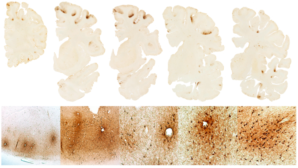 Slides from the neuropathological examination of Aaron Hernandez’s brain.